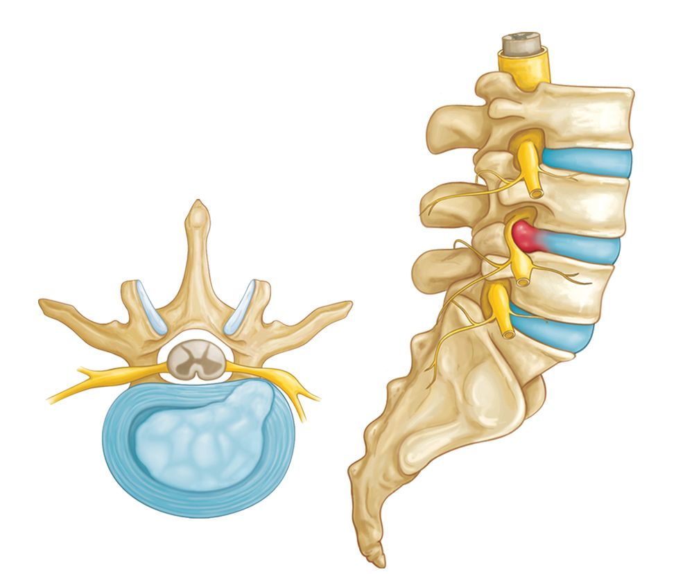 Disc Herniation illustration